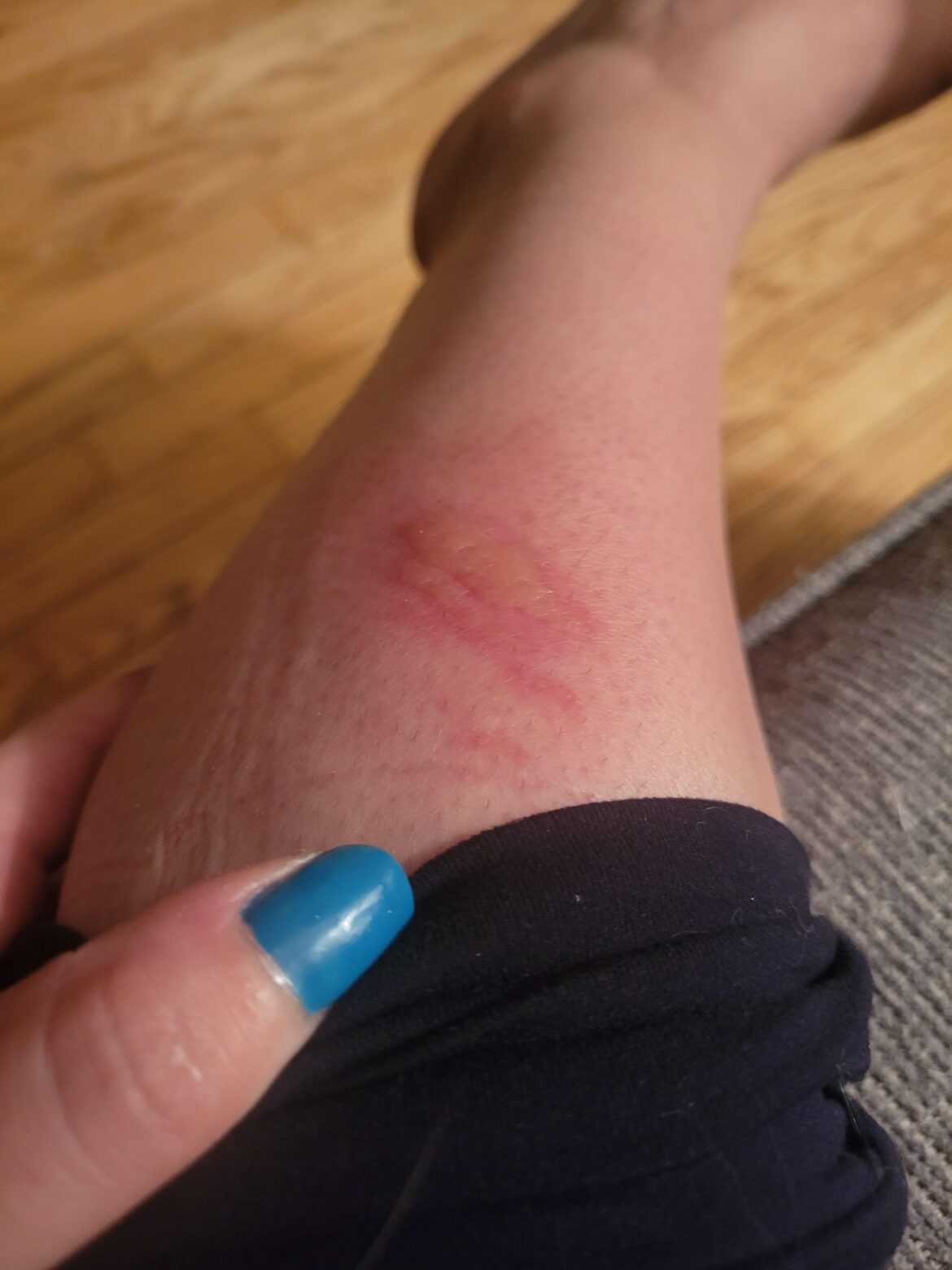 I don't know if this is allowed. A plant located in the GTA, Ontario caused this extremely painful blister