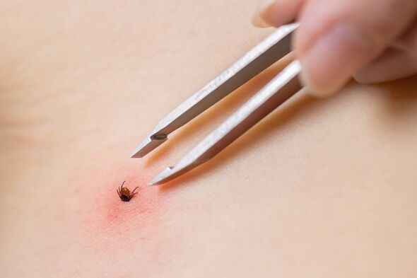 Removal with tweezers of a forest tick sucking blood in the human body - close-up.