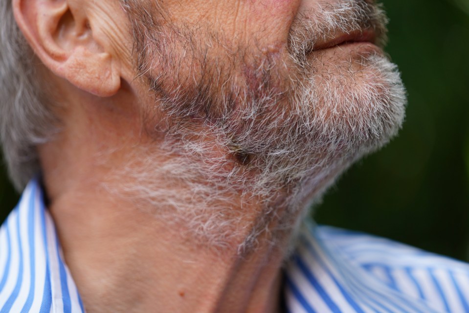 Christopher York, 65, from Chesterfield who accidentally cut his neck open with a chainsaw. June 27, 2025. A man who suffered "catastrophic blood loss" when he accidentally cut his neck open with a chainsaw while gardening has recalled a series of fortunate events that led to his survival. Christopher York was in his garden in Chesterfield, Derbyshire, when the chainsaw he was using became jammed, while cutting left to right, before it then followed through a branch and then "span around". The 65-year-old said he then felt a "cold wetness" at his front and saw his blood-covered shirt. Christopher said a number of coincidences, including a specialist vascular surgeon being on duty at the hospital he was rushed to who then operated on him, meant he lived, and has thanked NHS staff who helped him.