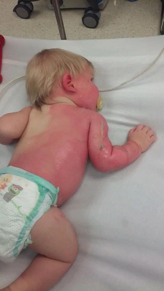 Infant with severe sunburn.