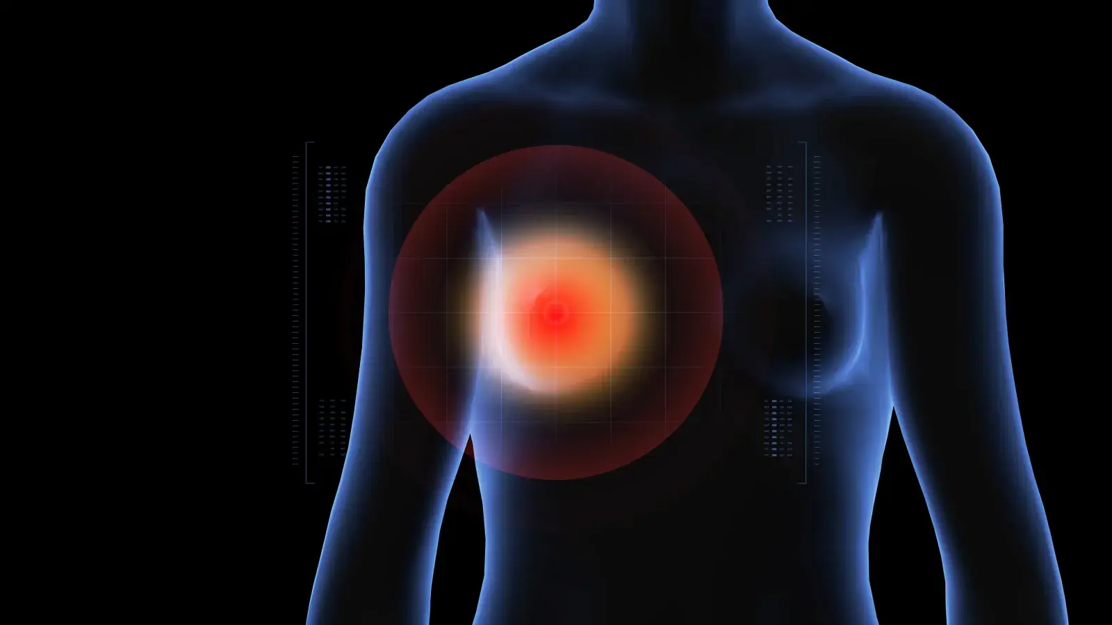 Breast inflammation in 3D
