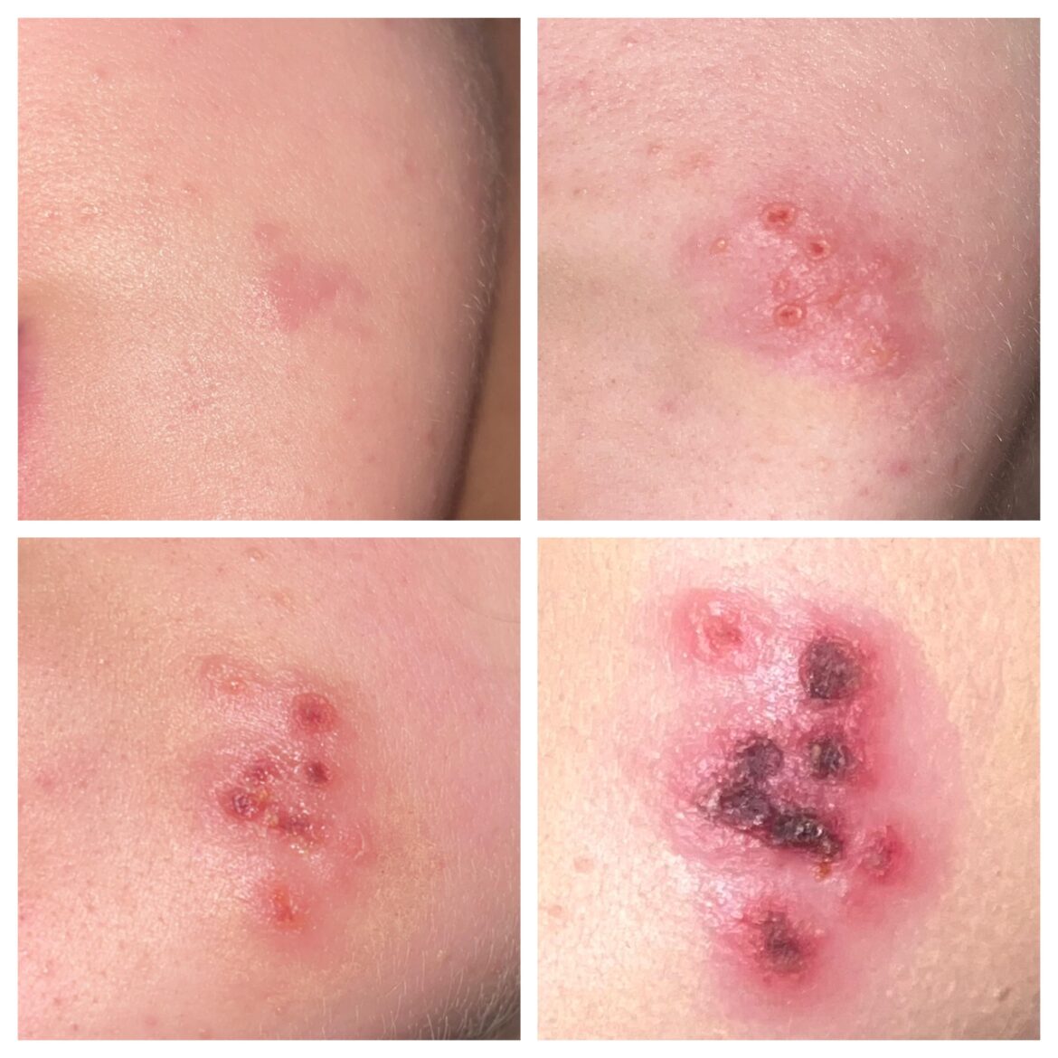 Does anyone know what kind of plant could’ve caused this burn on my face?