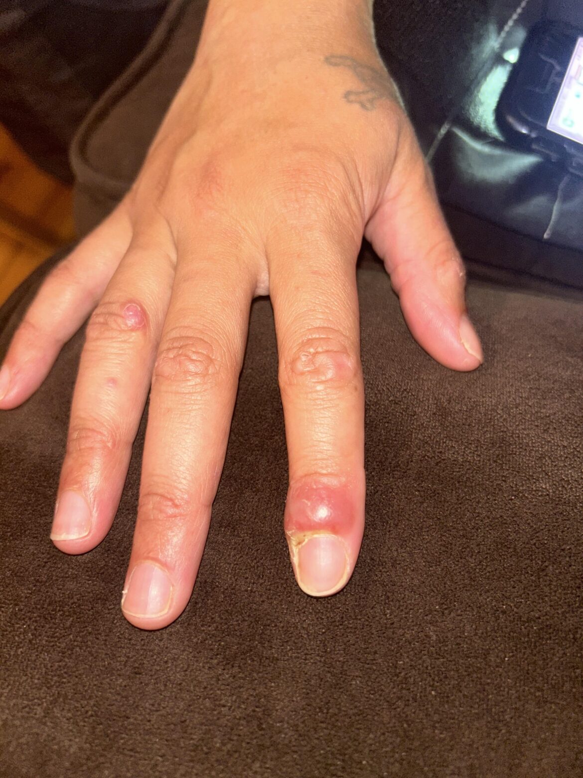 Concerning reaction after pricked by cholla cactus Concerning reaction after pricked by cholla cactus