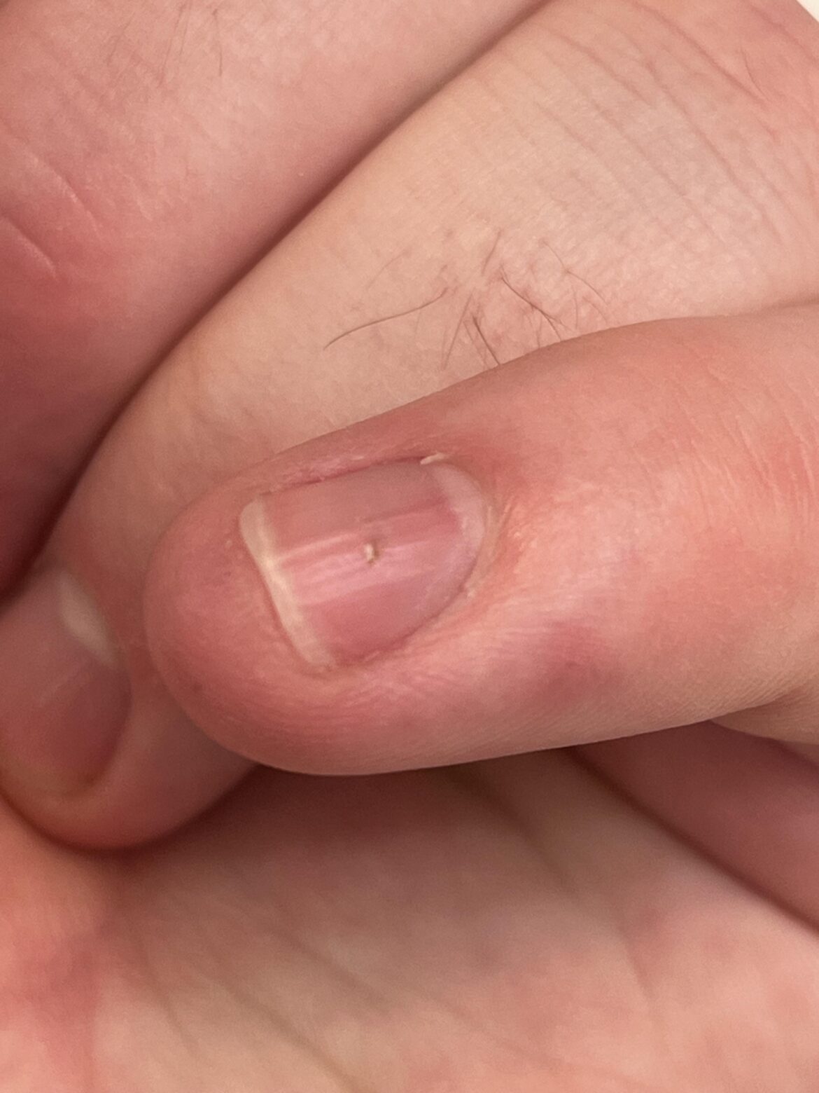 Tonight I accidentally hit my bridgesii and a spine went through my fingernail and is now stuck underneath my finger nail. Not sure what to do, I won’t be able to get it out myself. Anyone ever have this happen? Any suggestions? TIA