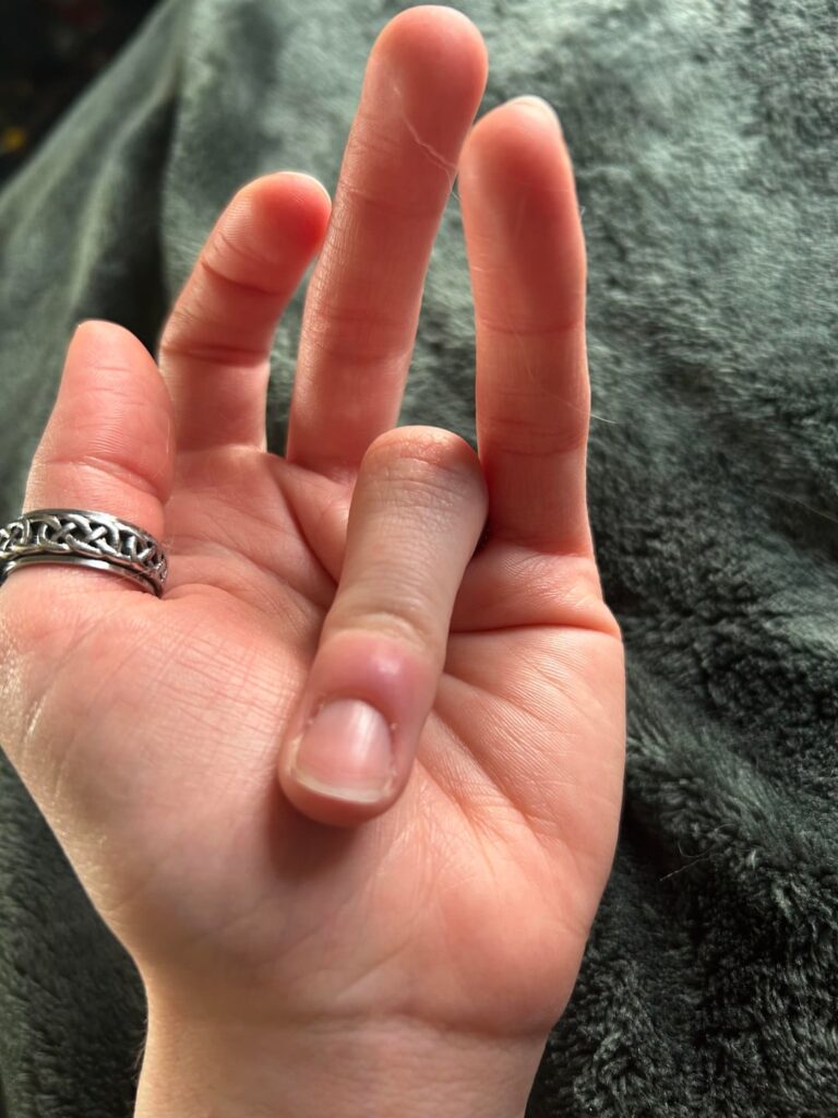 surgery to get thorn out?