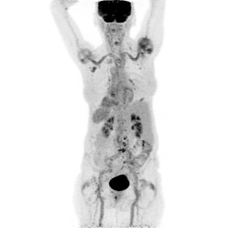 photo of FDG PET shows inflammation around the shoulder muscles and lower spine